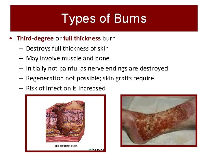 Types of Burns • Third-degree or full thickness burn – Destroys full thickness of