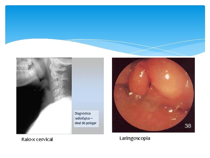 Raio-x cervical Laringoscopia 