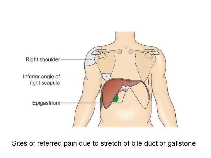 Sites of referred pain due to stretch of bile duct or gallstone 