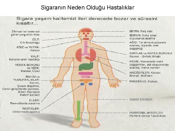 Sigaranın Neden Olduğu Hastalıklar 