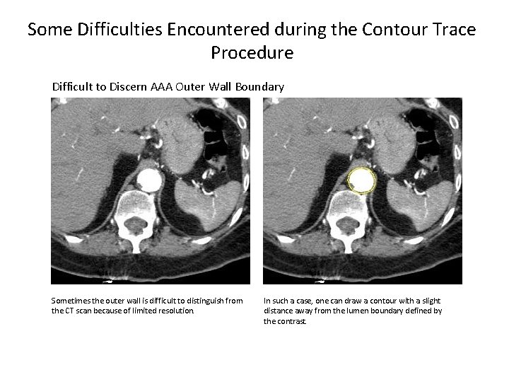 Some Difficulties Encountered during the Contour Trace Procedure Difficult to Discern AAA Outer Wall