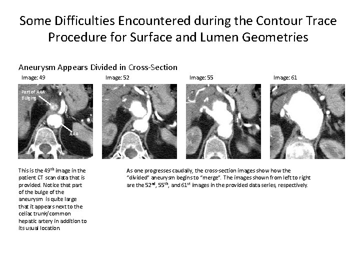 Some Difficulties Encountered during the Contour Trace Procedure for Surface and Lumen Geometries Aneurysm