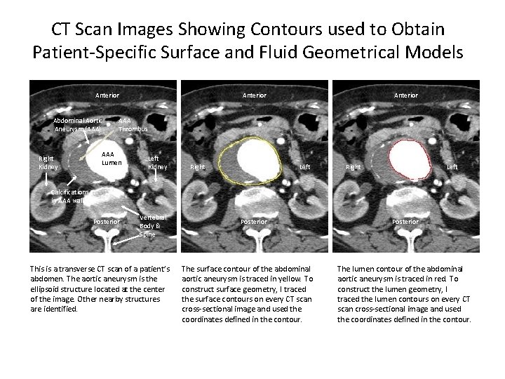 CT Scan Images Showing Contours used to Obtain Patient-Specific Surface and Fluid Geometrical Models