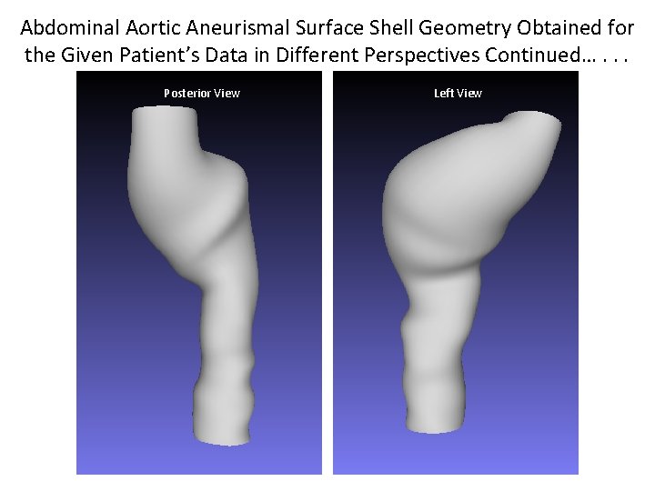 Abdominal Aortic Aneurismal Surface Shell Geometry Obtained for the Given Patient’s Data in Different
