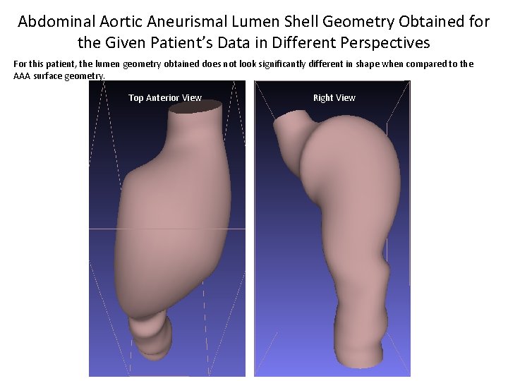 Abdominal Aortic Aneurismal Lumen Shell Geometry Obtained for the Given Patient’s Data in Different