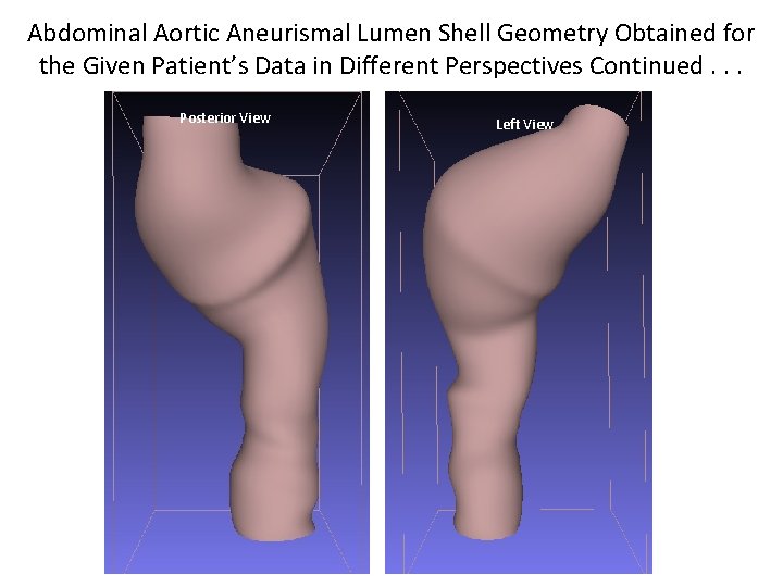 Abdominal Aortic Aneurismal Lumen Shell Geometry Obtained for the Given Patient’s Data in Different