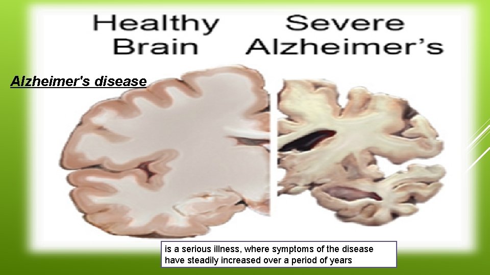 Alzheimer's disease is a serious illness, where symptoms of the disease have steadily increased