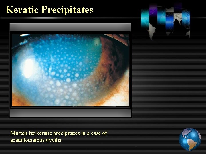 Keratic Precipitates Mutton fat keratic precipitates in a case of granulomatous uveitis 