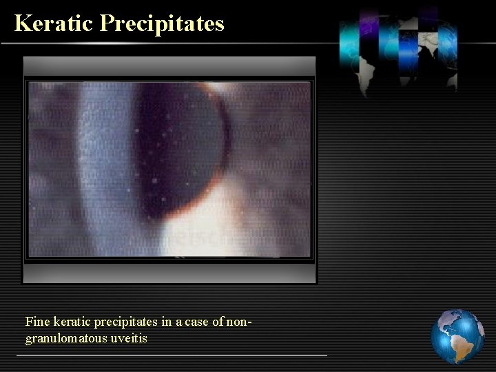 Keratic Precipitates Fine keratic precipitates in a case of nongranulomatous uveitis 