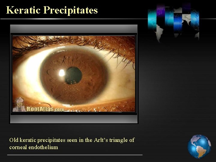 Keratic Precipitates Old keratic precipitates seen in the Arlt’s triangle of corneal endothelium 