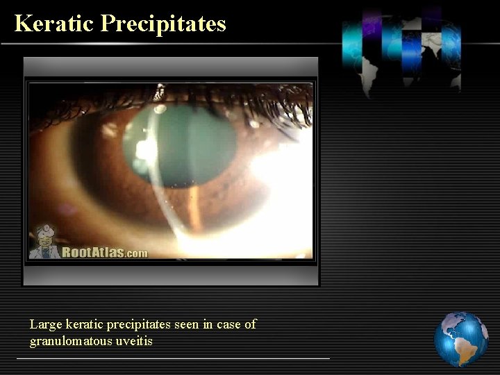 Keratic Precipitates Large keratic precipitates seen in case of granulomatous uveitis 