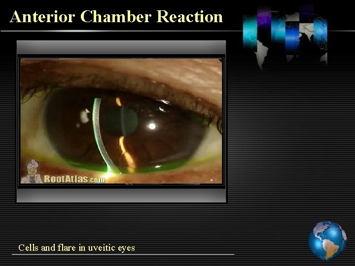 Anterior Chamber Reaction Cells and flare in uveitic eyes 