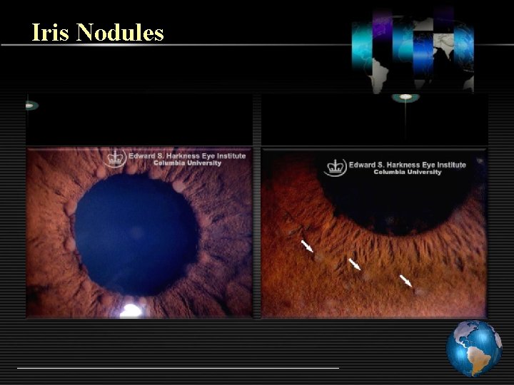 Iris Nodules 