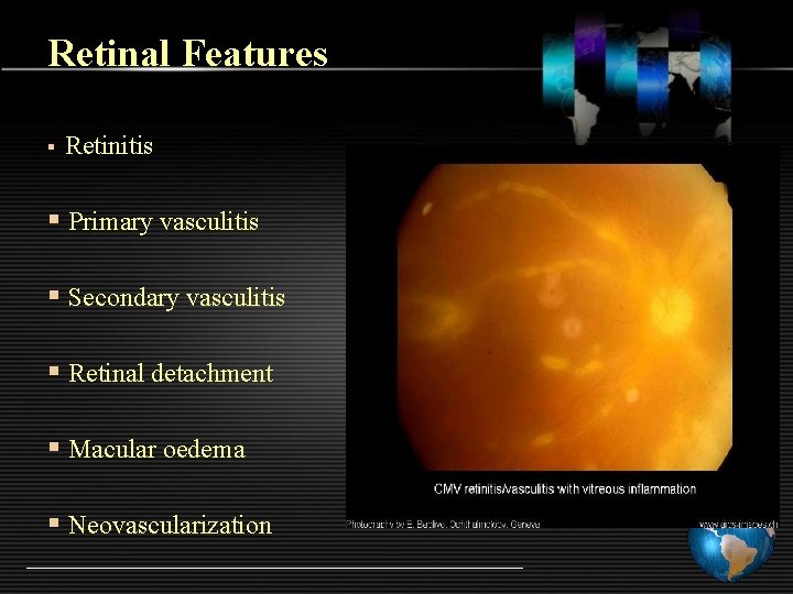 Retinal Features § Retinitis § Primary vasculitis § Secondary vasculitis § Retinal detachment §