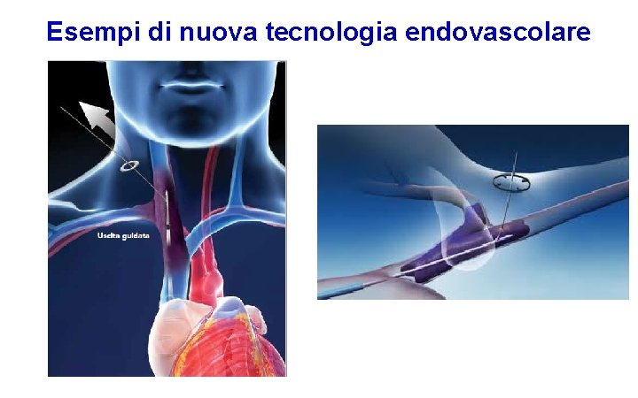 Esempi di nuova tecnologia endovascolare 