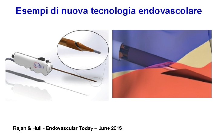 Esempi di nuova tecnologia endovascolare Rajan & Hull - Endovascular Today – June 2015