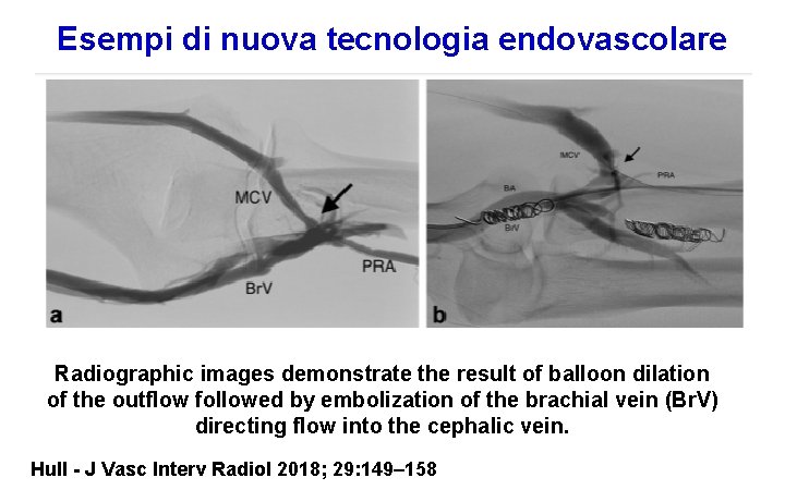 Esempi di nuova tecnologia endovascolare Radiographic images demonstrate the result of balloon dilation of