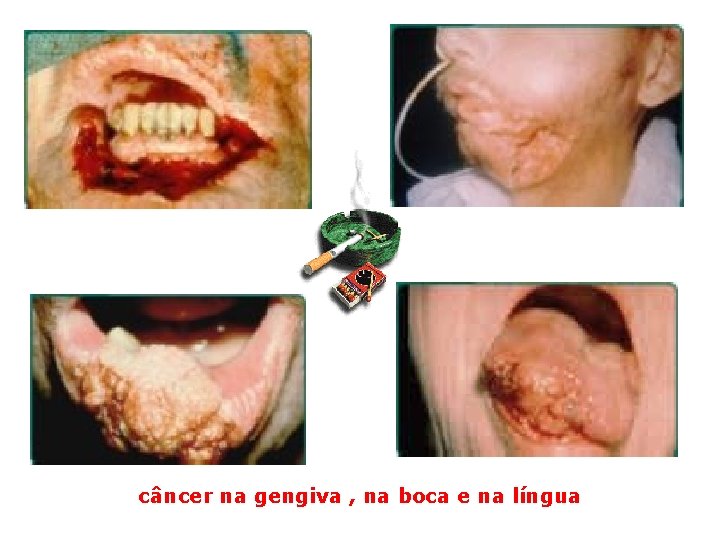 câncer na gengiva , na boca e na língua 