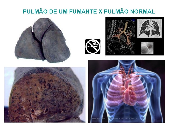 PULMÃO DE UM FUMANTE X PULMÃO NORMAL 