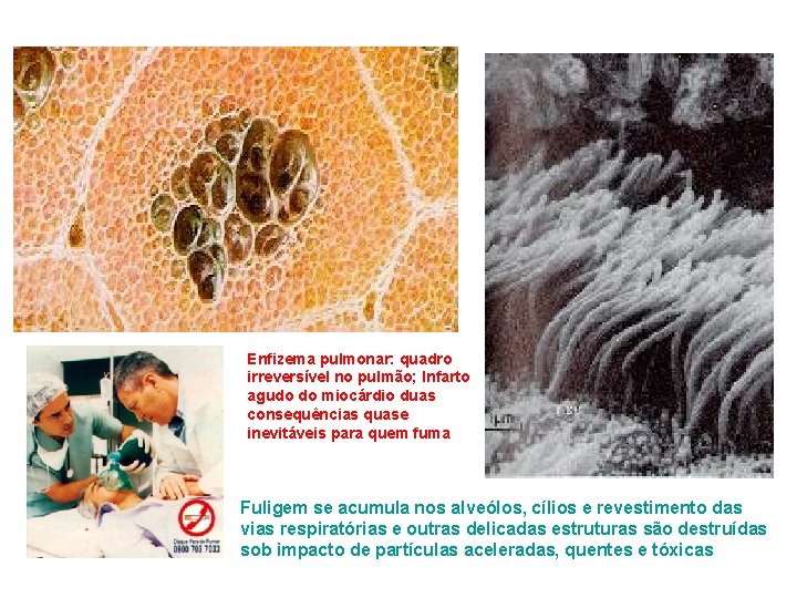 Enfizema pulmonar: quadro irreversível no pulmão; Infarto agudo do miocárdio duas consequências quase inevitáveis