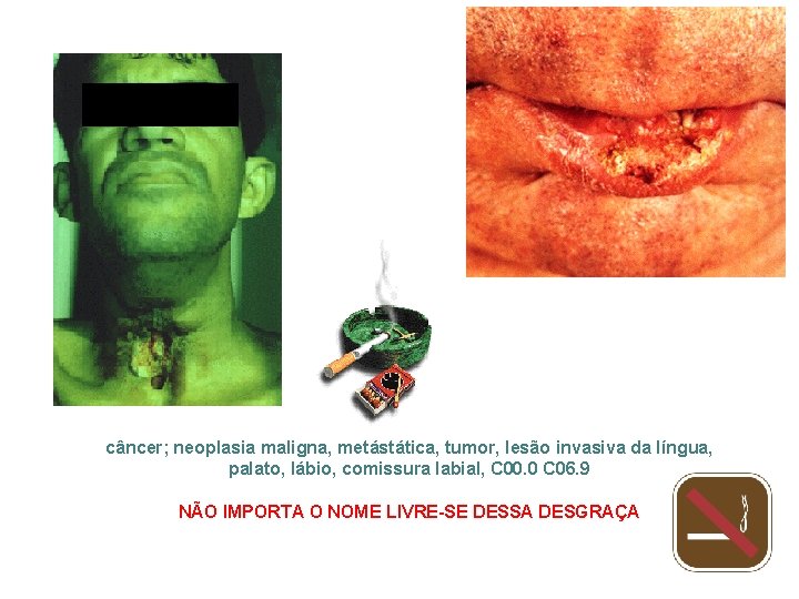câncer; neoplasia maligna, metástática, tumor, lesão invasiva da língua, palato, lábio, comissura labial, C
