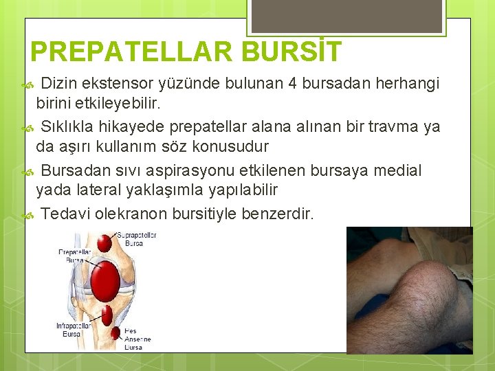 PREPATELLAR BURSİT Dizin ekstensor yüzünde bulunan 4 bursadan herhangi birini etkileyebilir. Sıklıkla hikayede prepatellar