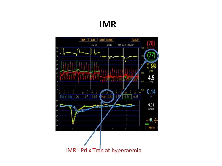 IMR IMR= Pd x Tmn at hyperaemia 