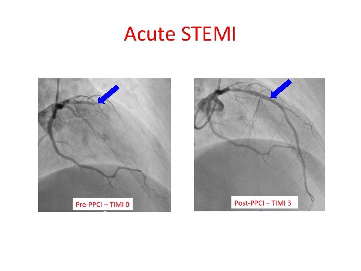 Acute STEMI 