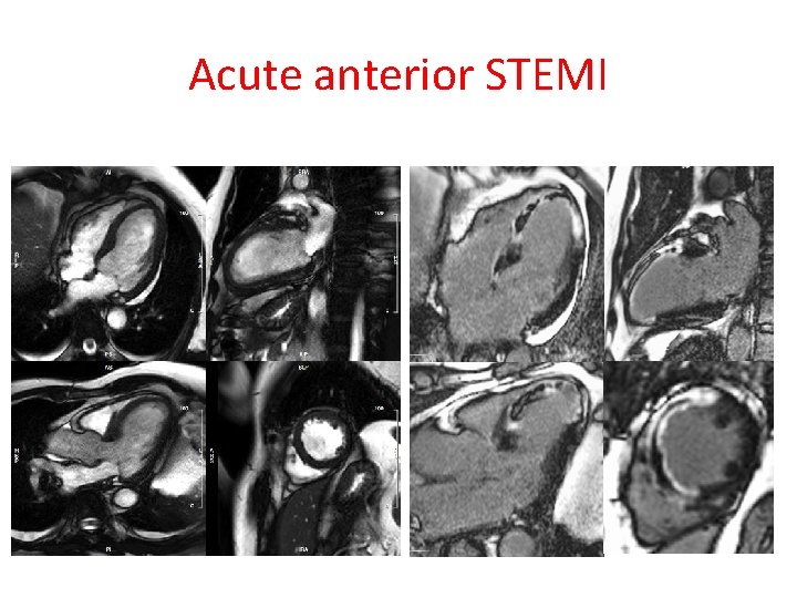 Acute anterior STEMI 
