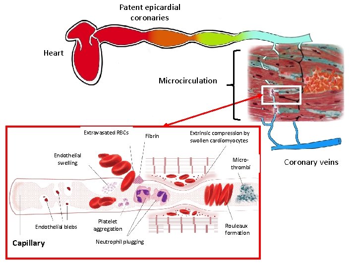 Patent epicardial coronaries Heart Microcirculation Extravasated RBCs Endothelial swelling Endothelial blebs Capillary Fibrin Extrinsic