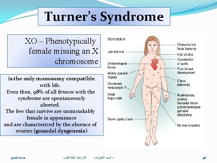 Turner’s Syndrome XO – Phenotypically female missing an X chromosome is the only monosomy