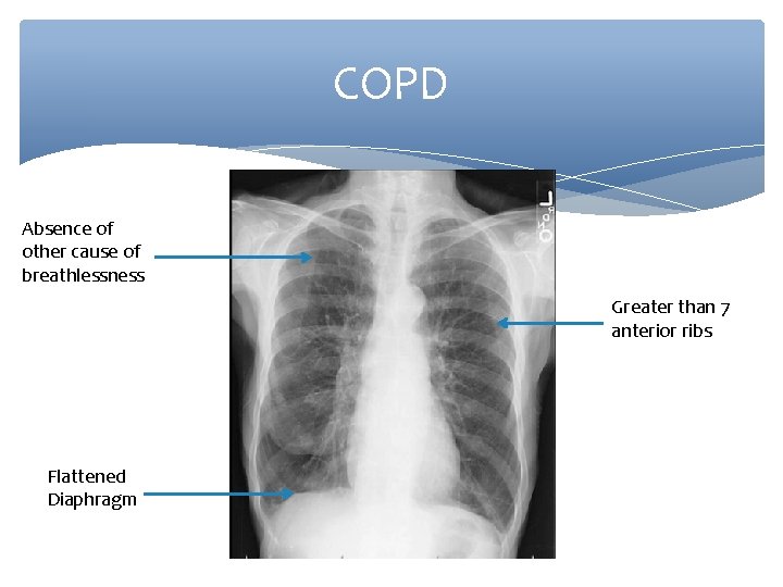 COPD Absence of other cause of breathlessness Greater than 7 anterior ribs Flattened Diaphragm