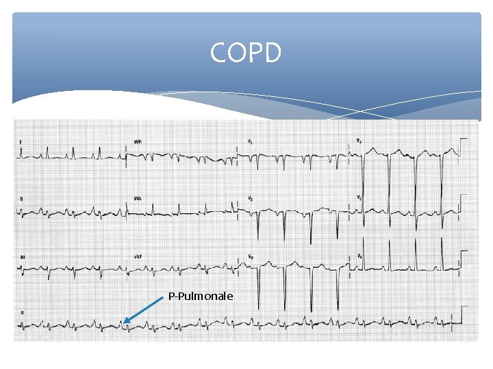 COPD P-Pulmonale 