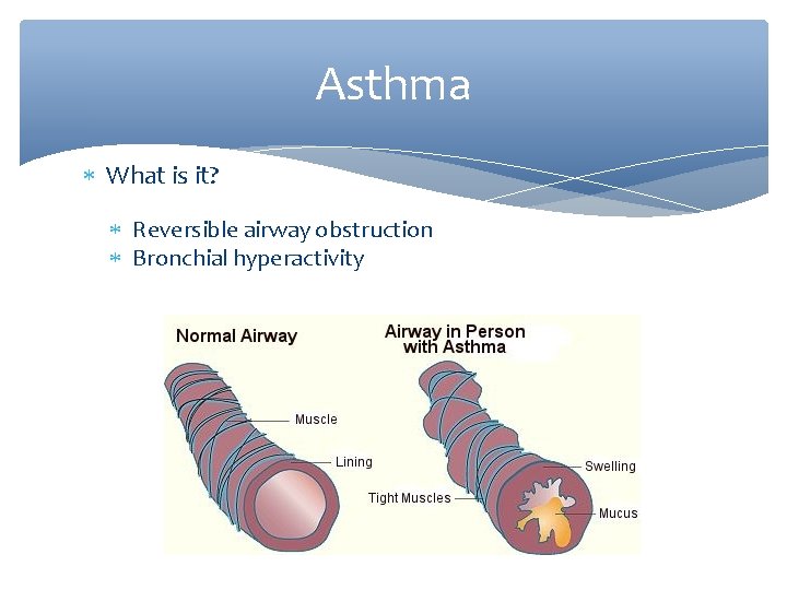 Asthma What is it? Reversible airway obstruction Bronchial hyperactivity 