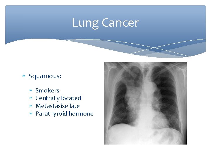 Lung Cancer Squamous: Smokers Centrally located Metastasise late Parathyroid hormone 