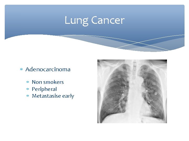 Lung Cancer Adenocarcinoma Non smokers Peripheral Metastasise early 