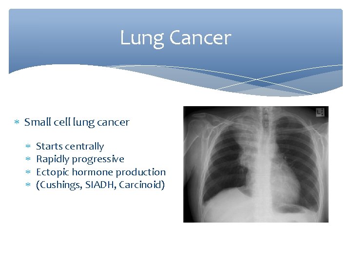 Lung Cancer Small cell lung cancer Starts centrally Rapidly progressive Ectopic hormone production (Cushings,