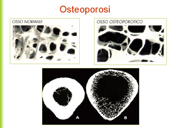 Osteoporosi 