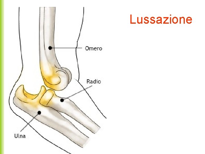 Lussazione 