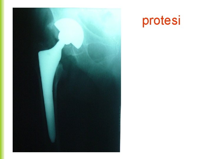 protesi 