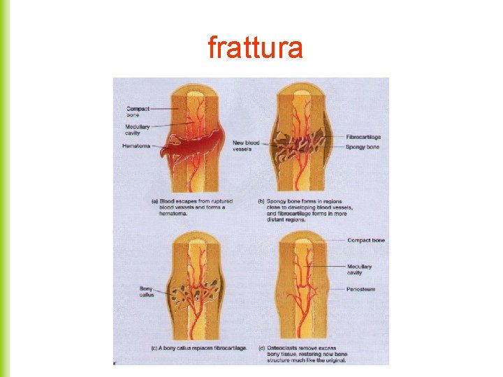 frattura 