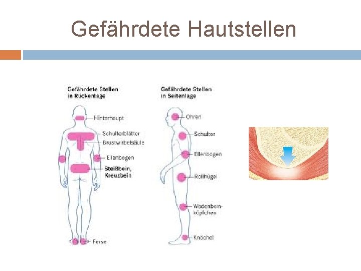 Gefährdete Hautstellen 