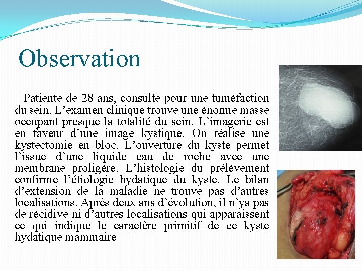 Observation Patiente de 28 ans, consulte pour une tuméfaction du sein. L’examen clinique trouve