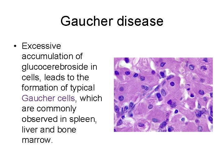Gaucher disease • Excessive accumulation of glucocerebroside in cells, leads to the formation of