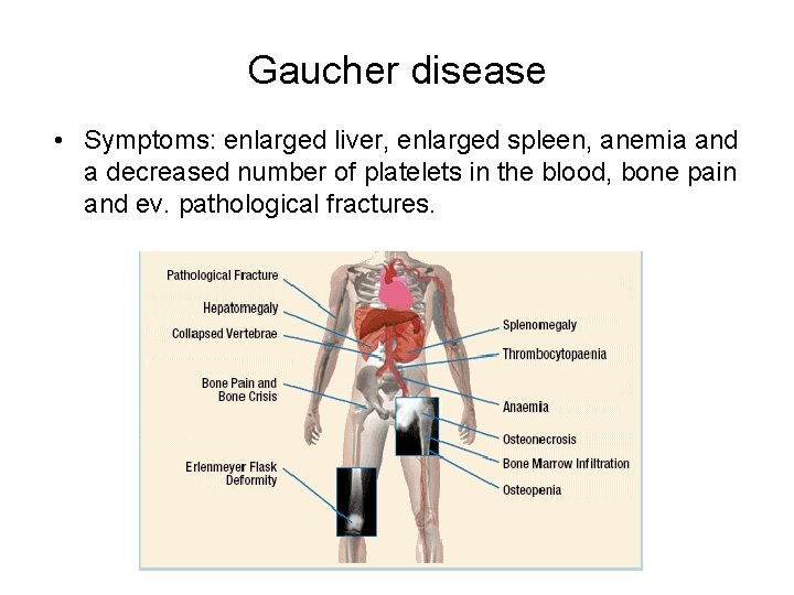Gaucher disease • Symptoms: enlarged liver, enlarged spleen, anemia and a decreased number of