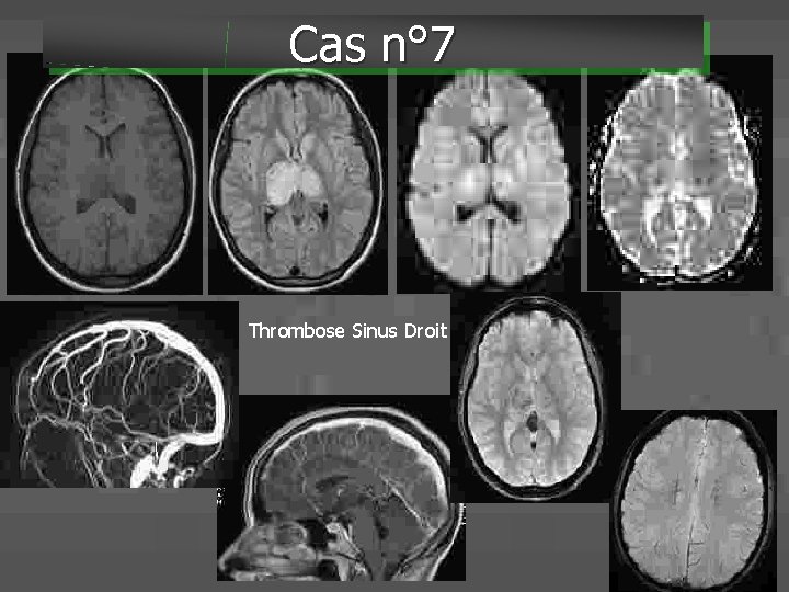 Cas n° 7 Thrombose Sinus Droit 