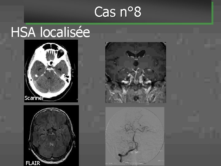 Cas n° 8 HSA localisée Scanner FLAIR 