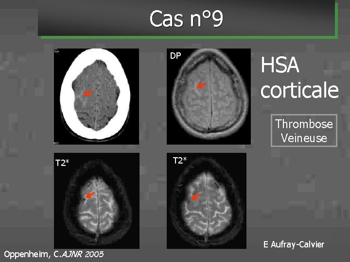 Cas n° 9 DP HSA corticale Thrombose Veineuse T 2* Oppenheim, C. AJNR 2005