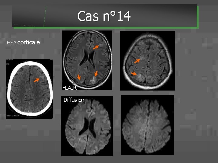 Cas n° 14 HSA corticale FLAIR Diffusion 