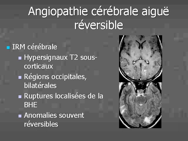 Angiopathie cérébrale aiguë réversible n IRM cérébrale n Hypersignaux T 2 souscorticaux n Régions